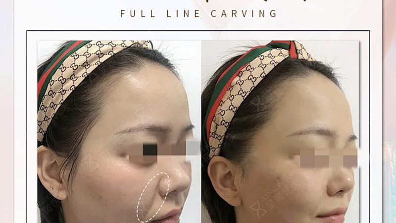 水光针术后护肤品选择，揭秘如何呵护肌肤