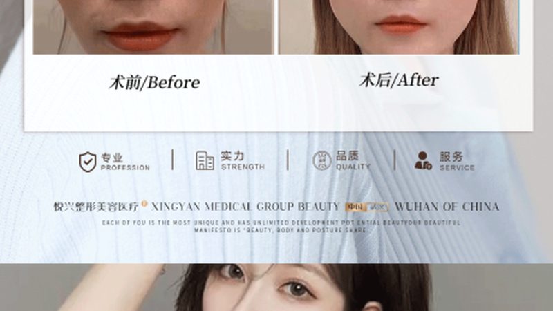 小标题：了解埋线提升