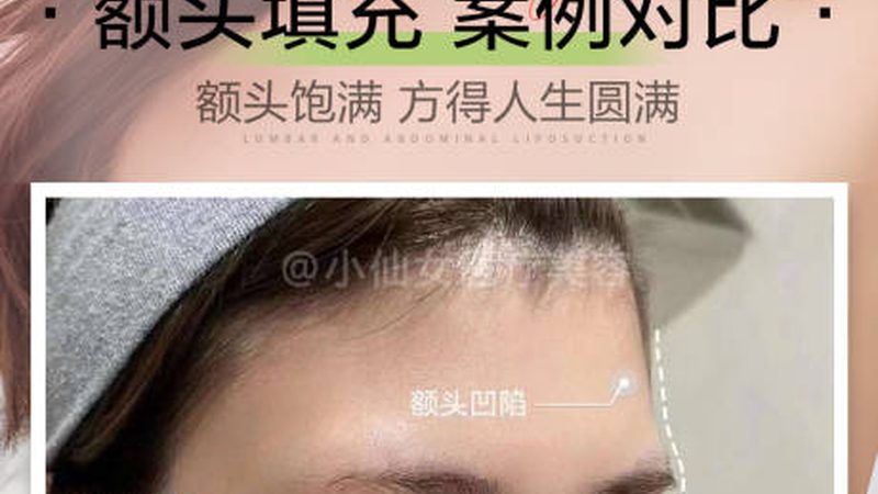 玻尿酸注射，成都地区价格揭秘与选择指南