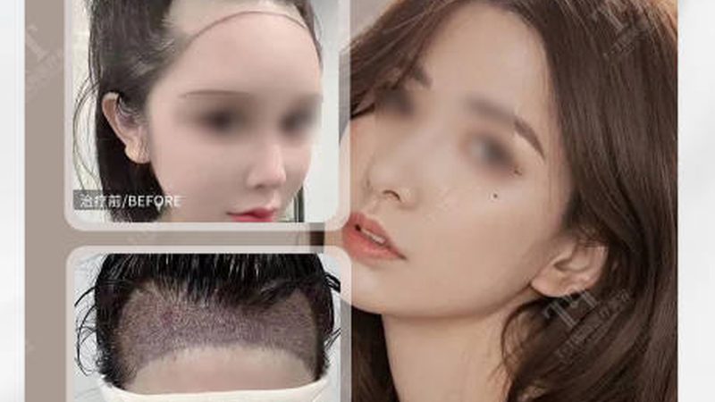 整形美容术后恢复期：揭秘恢复过程中的关键点**