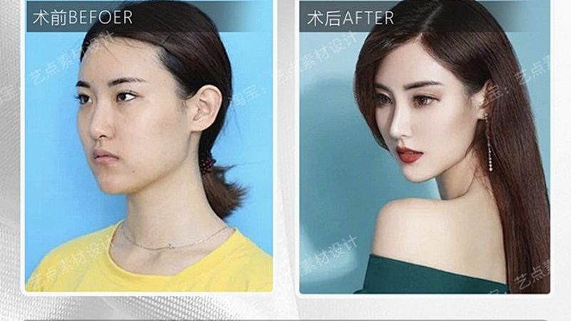小标题：隆鼻手术的必要性