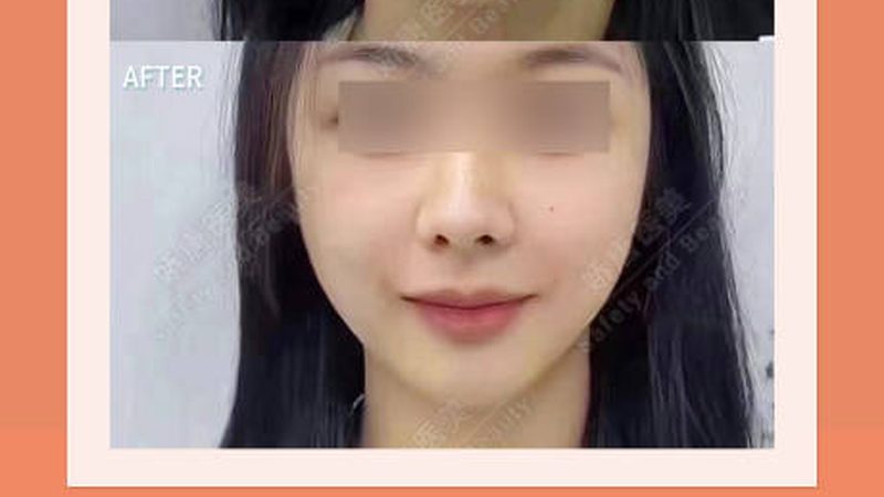 肉毒素除抬头纹，真实案例揭秘效果与过程