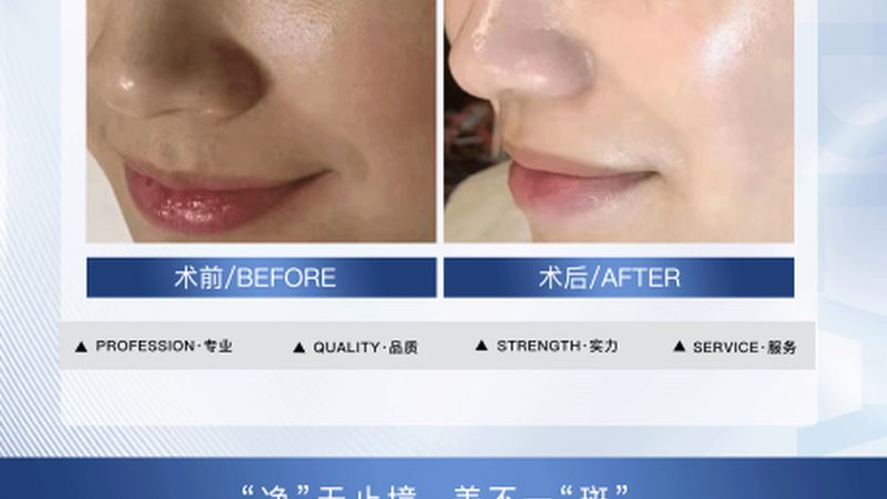 热玛吉效果能维持多久？揭秘其持久力的秘密