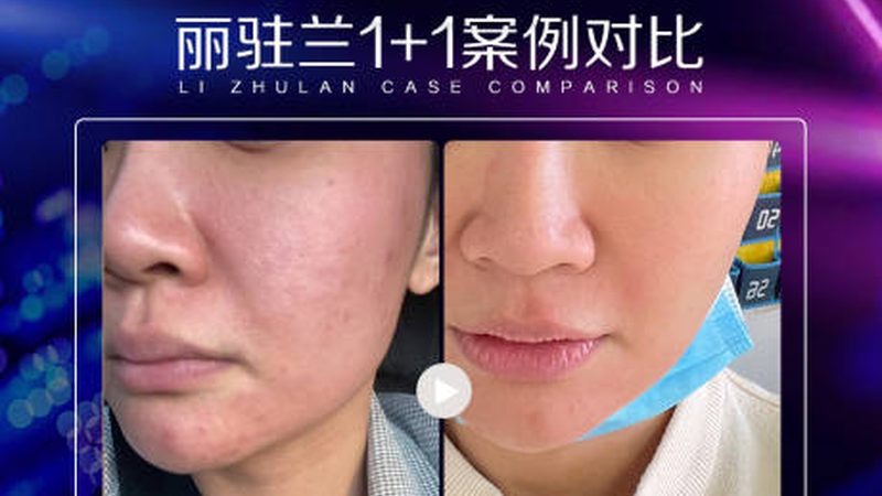 玻尿酸代理哪家强？揭秘成都市场优质选择