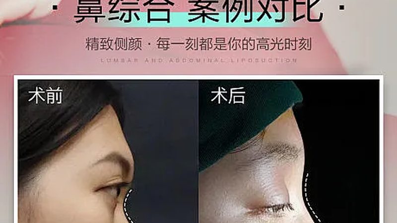 隆鼻修复与鼻综合：揭秘两者间的差异**