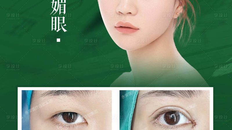 全切双眼皮与埋线：适合人群差异解析**